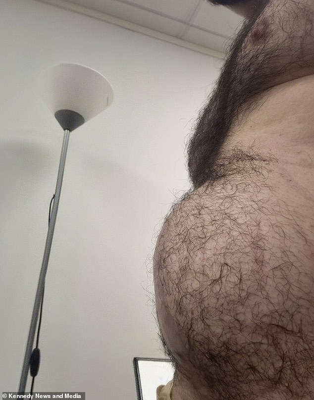 Las hernias son un problema común que ocurre cuando una parte interna del cuerpo pasa a través de un punto débil en el músculo o en la pared del tejido circundante, dice el NHS.