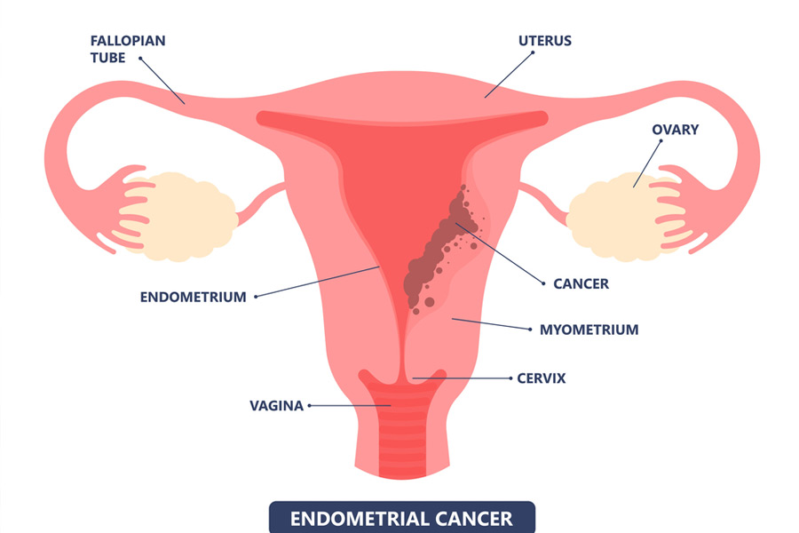 cáncer endometrial