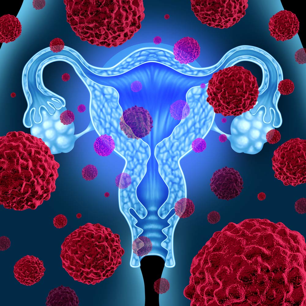 cáncer de ovarios