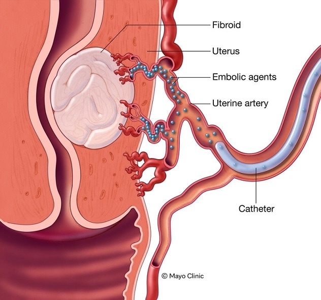 embolización de la arteria uterina
