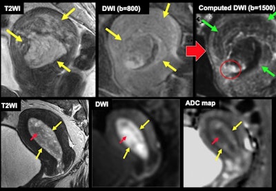 Cáncer de endometrio en pólipos endometriales (fila superior de tres imágenes): las lesiones cancerosas son claramente visibles debido a la señal reducida del pólipo con valores b altos en imágenes ponderadas por difusión computarizada (DWI). Cáncer de endometrio en hiperplasia endometrial (fila inferior de tres imágenes): los focos de cáncer son claramente visibles en el mapa ADC como áreas de bajo coeficiente de difusión aparente (ADC). Flecha roja = cáncer. Flecha amarilla = pólipo/hiperplasia. Flecha verde = disminución de la señal del pólipo con valores b altos en DWI computarizado.