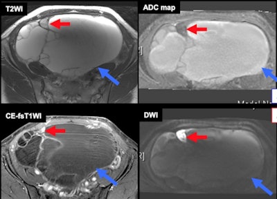 Metástasis dentro de tumores benignos de ovario. Algunas neoplasias malignas de alto grado, como el carcinoma intraepitelial seroso de las trompas de Falopio (STIC), pueden metastatizarse en el ovario o en lesiones ováricas benignas e imitar una transformación maligna. Flecha azul = tumor mucinoso benigno. Flecha roja = carcinoma seroso de alto grado. Todas las imágenes son cortesía del Dr. Mayumi Takeuchi, el Dr. Kenji Matsuzaki y el Prof. Masafumi Harada y se presentaron en ECR 2023.