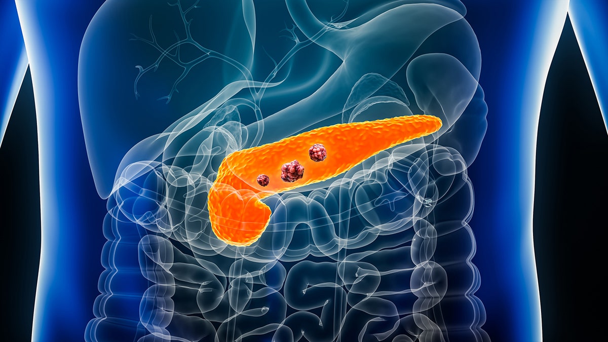 Representación 3D del cáncer de páncreas