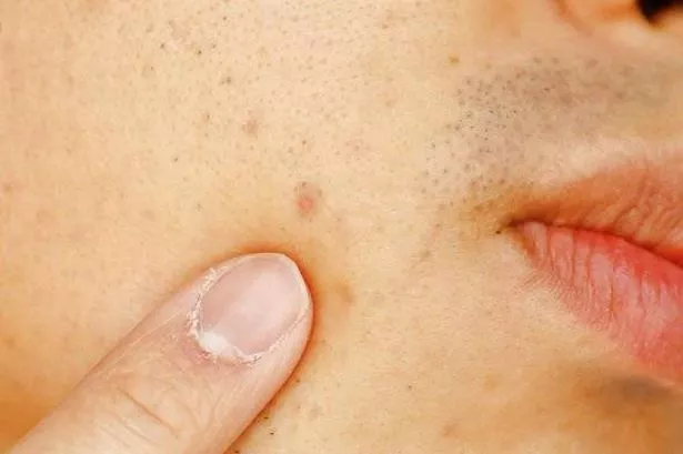 Deficiencia de vitamina B12: pigmentación