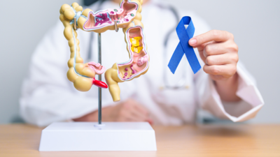 Vitamina D y cáncer colorrectal: una nueva investigación muestra cómo reducir las posibilidades de que este cáncer sea casi el 60%