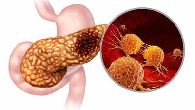 Advertencia de cáncer gástrico: la deficiencia de vitamina A puede aumentar su riesgo; conocer los síntomas clave